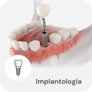 Implantología